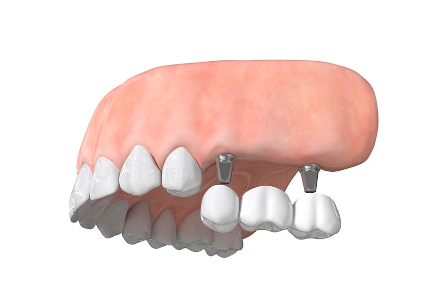 Dental Implant Bridge in Lyndhurst, OH