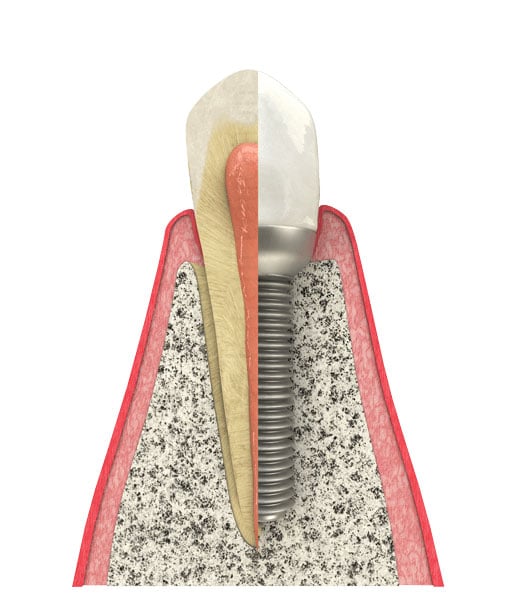 Benefits of Dental Implants in Lyndhurst, OH