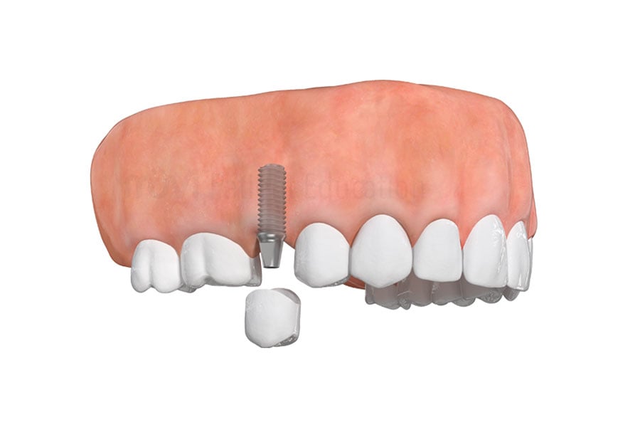 Dental Implant in Lyndhurst, OH