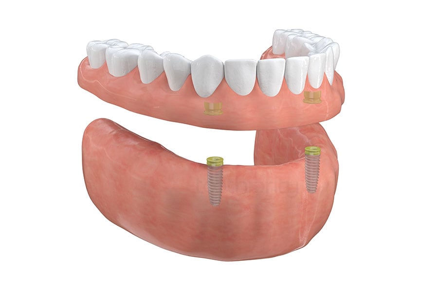 Implant-Supported Overdentures in Lyndhurst, OH