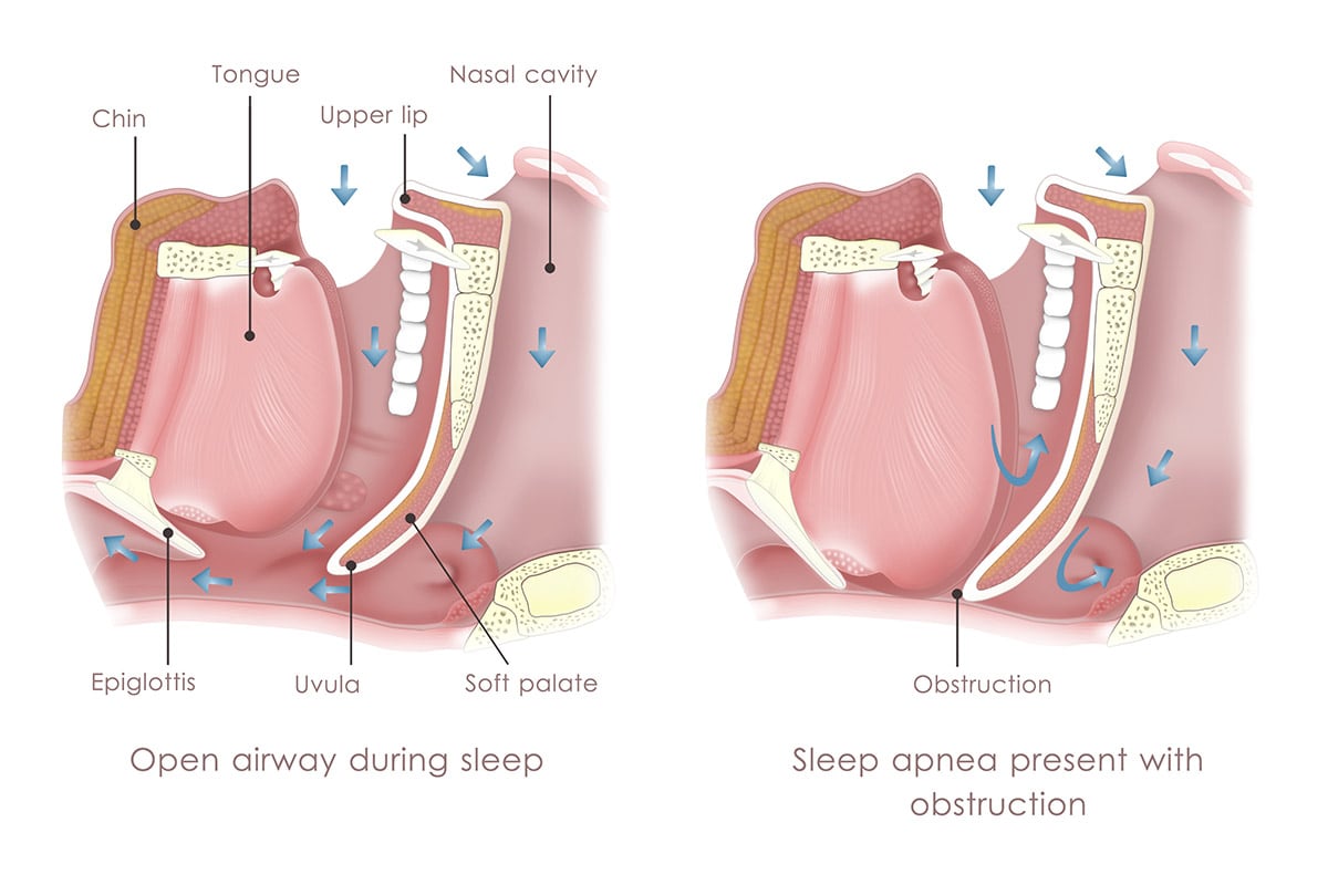 Sleep Apnea in Lyndhurst, OH